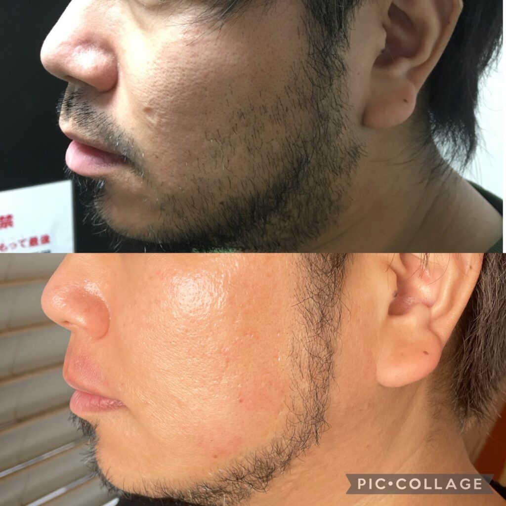 デザイン脱毛Before & After