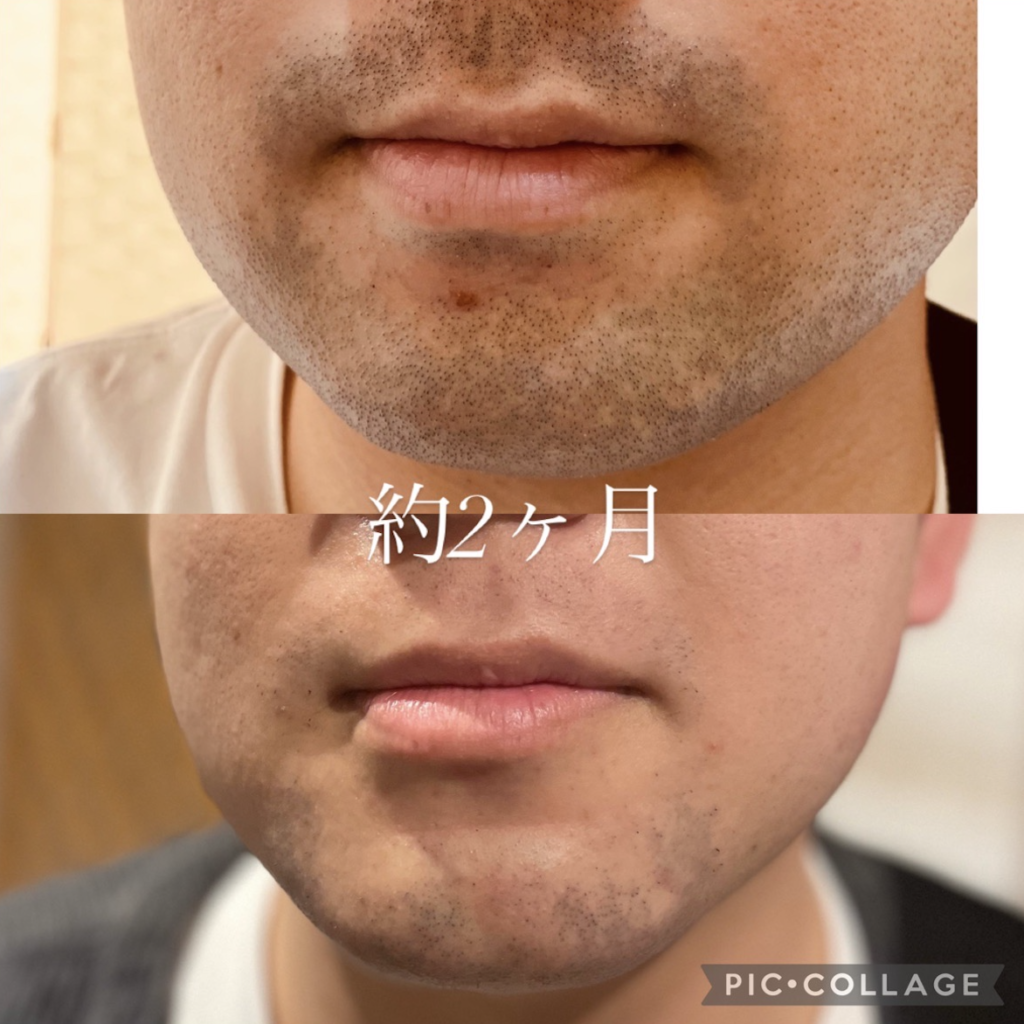 ひげ脱毛 開始２ヶ月 Before & After